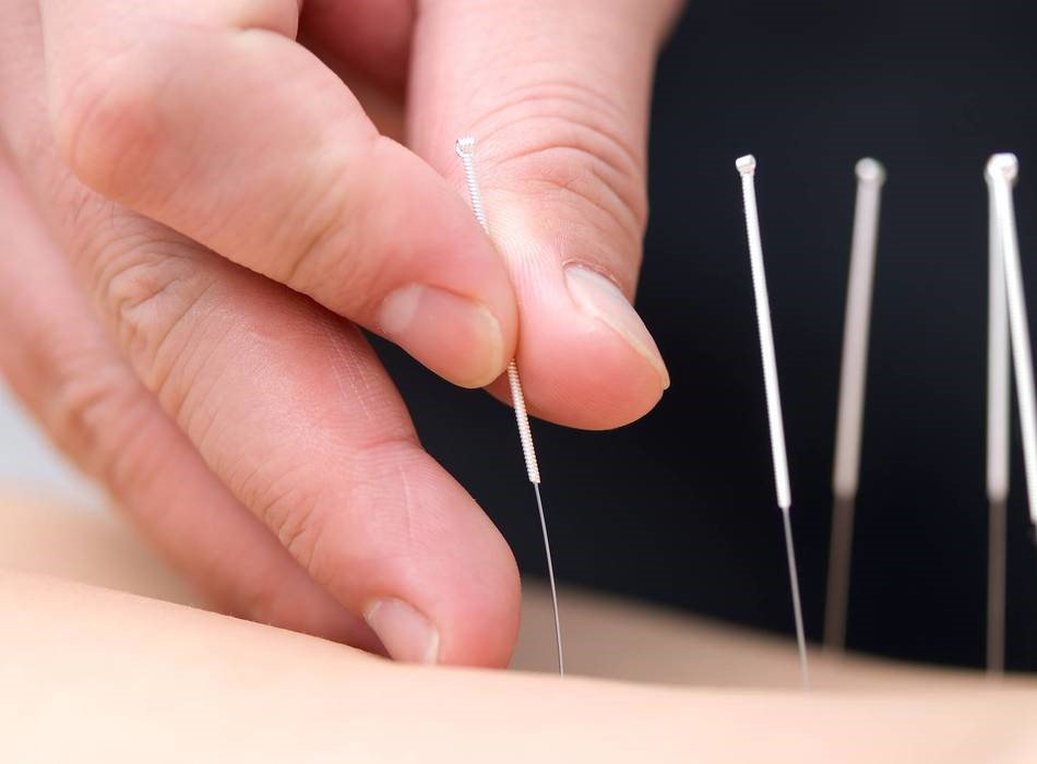 Một số điểm đáng lưu ý khi mở phòng khám y học cổ truyền thực hiện châm cứu