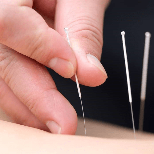 Điều kiện để được mở phòng châm cứu bấm huyệt